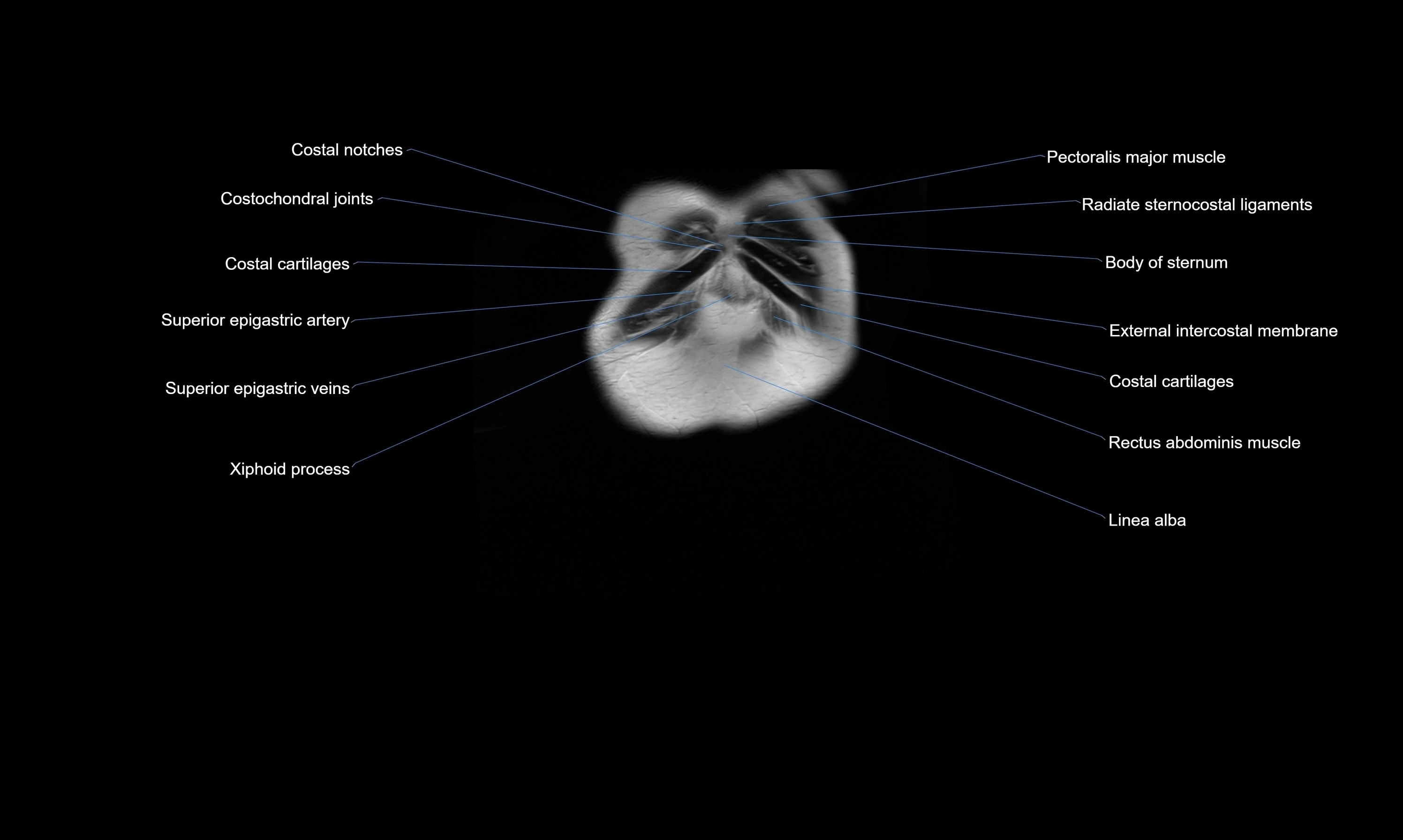 MRI Abdomen axial cross sectional anatomy radiology  image-img-00001-00004.webp